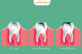 راه های جلوگیری از پوسیدگی دندان + 12 راهکار