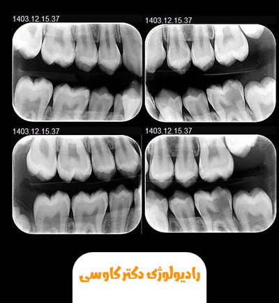 رادیوگرافی بایت وینگ (بین دندانی) چیست؟ + کاربرد