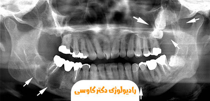 کیست فکی چیست؟ | روش تشخیص و درمان آن